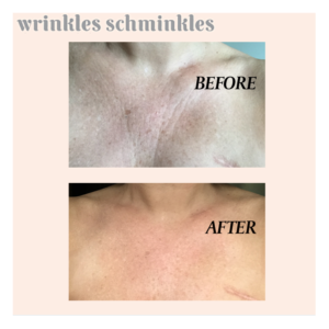 Chest-Wrinkles-Before-and-After-FITS-2